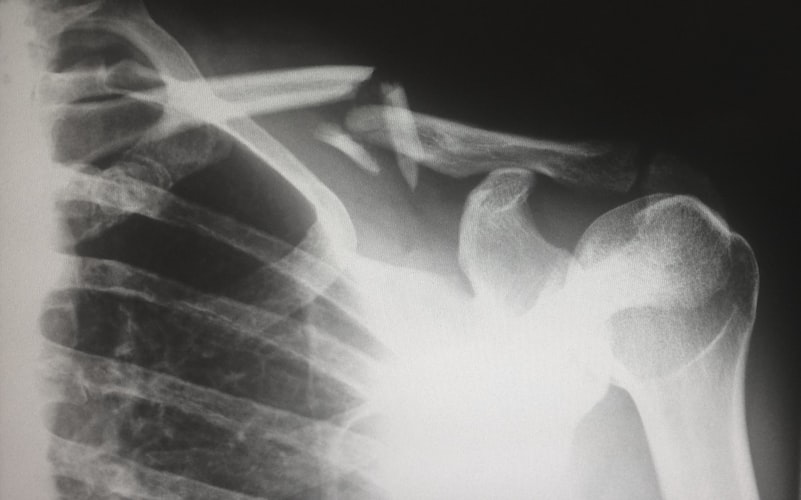 rentgen zlomené klíční kosti
